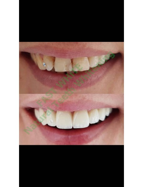 Fast Whıte Natural Teeth Whitening 10 Ml Diş Beyazlatma Ve Tartar Temizleme 